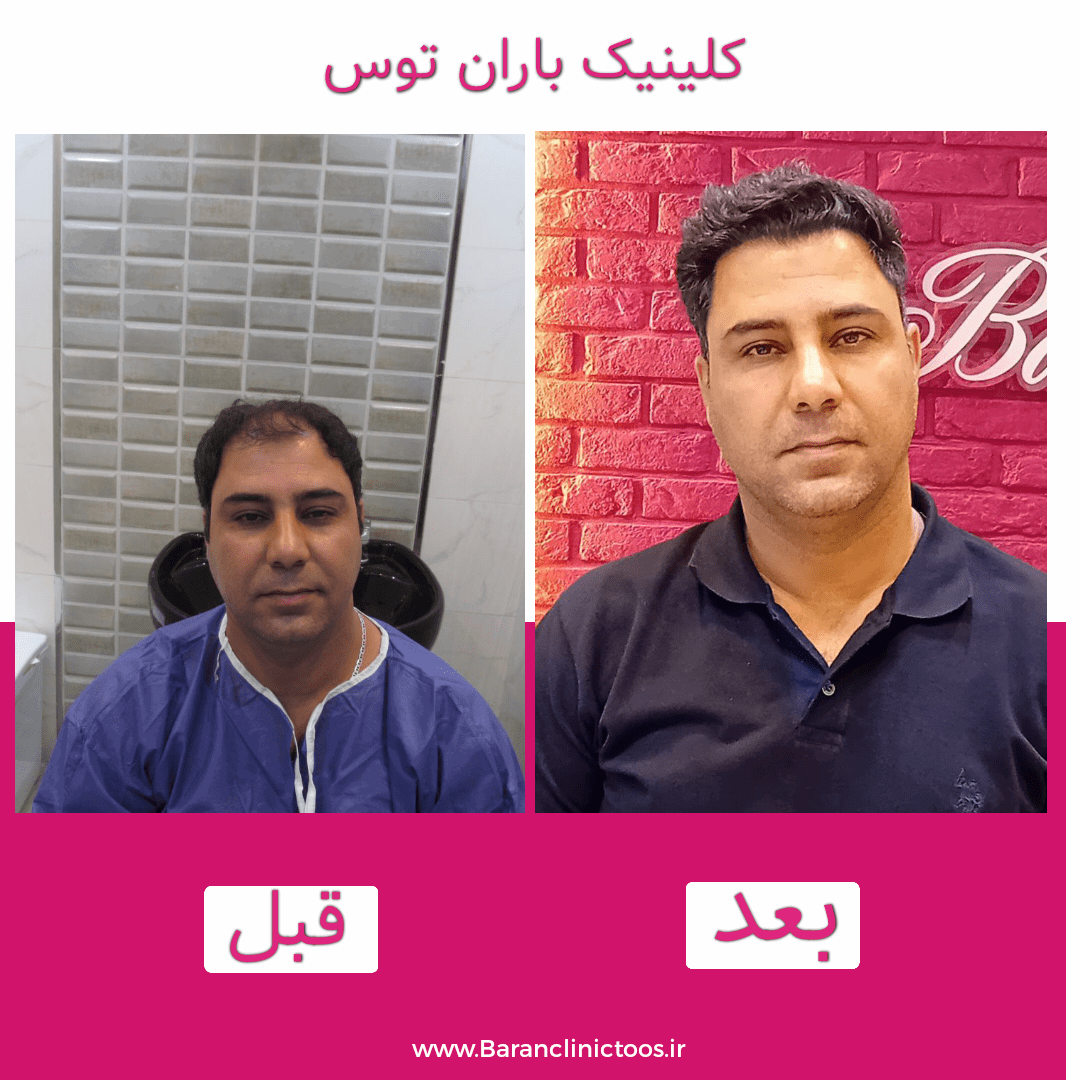 قبل و بعد کاشت مو